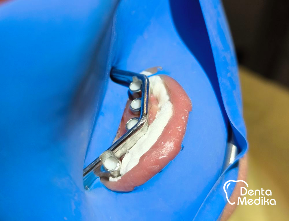 Třmenová hybridní náhrada na implantátech pro bezzubou čelist 6